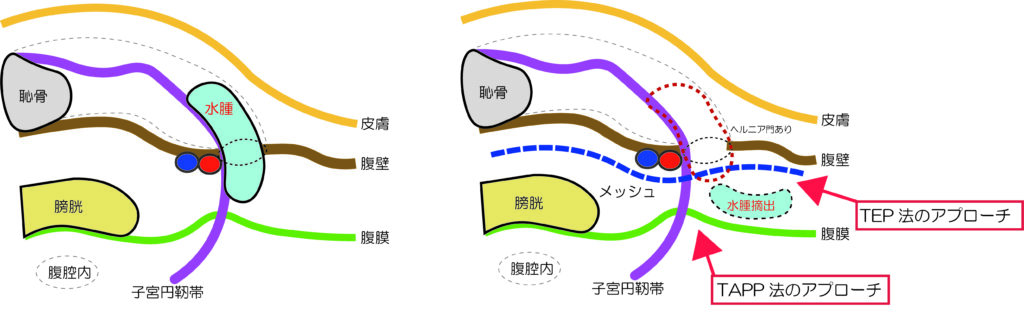 ヌック管水腫が内鼠径輪をまたいで存在しているイラスト（治療）
