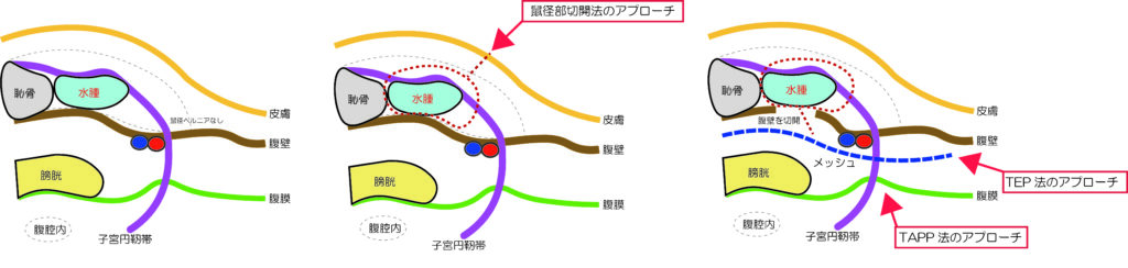 ヌック管水腫が鼠径管内に存在している状態のイラスト（治療）