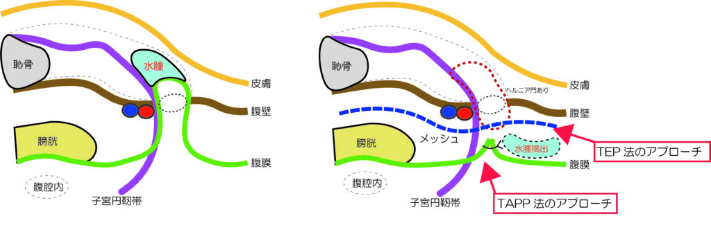 鼠径ヘルニアとヌック管水腫の併存のイラスト（治療）