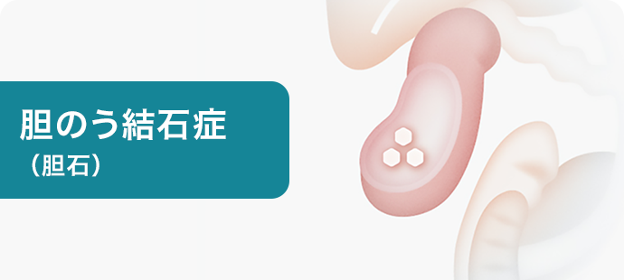 胆のう結石症（胆石）
