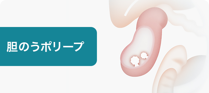 胆のうポリープ