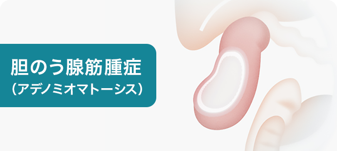 胆のう腺筋腫症（アデノミオマトーシス）