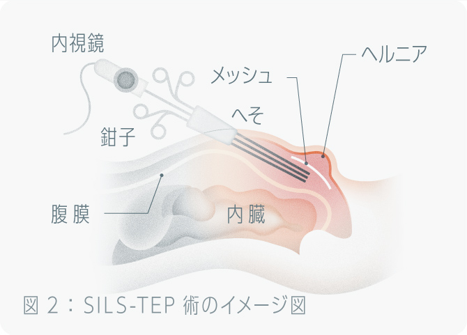 SILS-TEP術のイメージ図