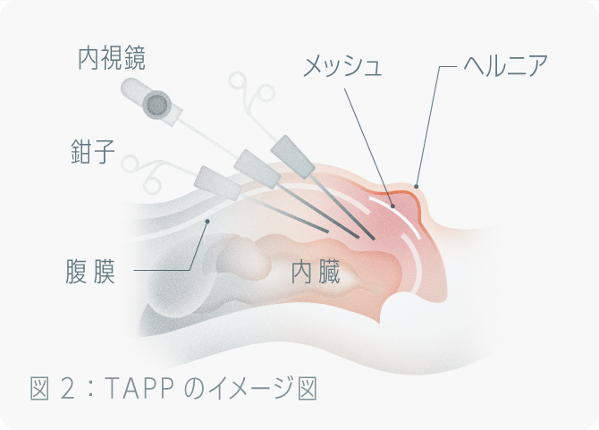 TAPP術のイメージ図