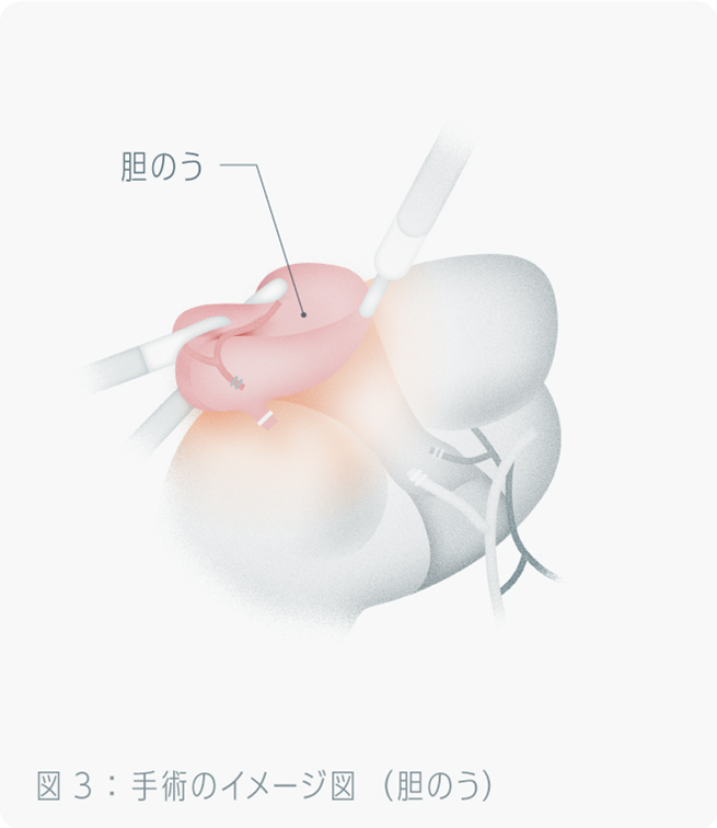 手術のイメージ図(胆のう)
