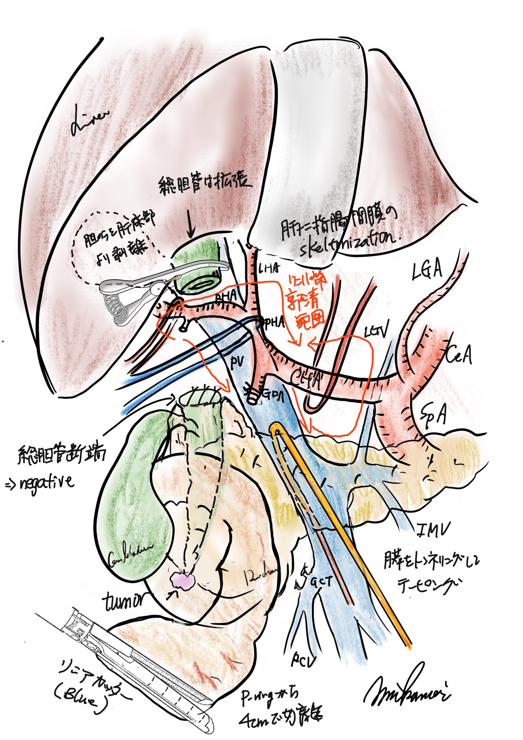 新 手術記録の書き方 4 91vQKK2z-4L._AC_UF350,
