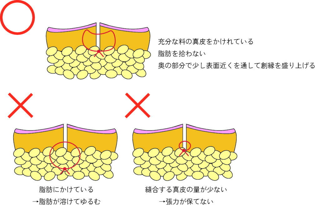 正しい真皮縫合の方法