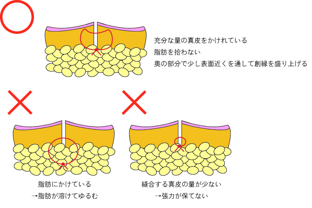 よい真皮縫合の方法について